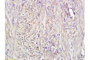 Formalin-fixed and paraffin embedded human cervical carcinoma labeled with Mouse Anti-AFP(A4) Monoclonal Antibody, Unconjugated (bsm-1622M) at 1:200 followed by conjugation to the secondary antibody and DAB staining. (alpha Fetoprotein anticorps)