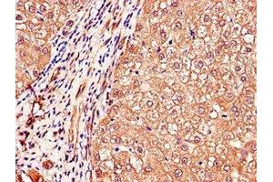 Immunohistochemistry of paraffin-embedded human liver cancer using ABIN7150398 at dilution of 1:100 (IGHMBP2 anticorps  (AA 646-884))