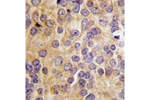 IHC analysis of FFPE human prostate carcinoma tissue stained with PRMT3 antibody