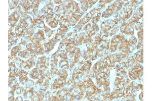 Formalin-fixed, paraffin-embedded human Thyroid Carcinoma stained with EpCAM Rabbit Recombinant Monoclonal Antibody (EGP40/1555R).