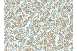 Formalin-fixed, paraffin-embedded human Thyroid Carcinoma stained with EpCAM Rabbit Recombinant Monoclonal Antibody (EGP40/1555R). (Recombinant EpCAM anticorps  (N-Term))
