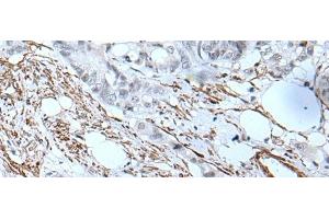 Immunohistochemistry of paraffin-embedded Human colorectal cancer tissue using GJA5 Polyclonal Antibody at dilution of 1:50(x200) (Cx40/GJA5 anticorps)