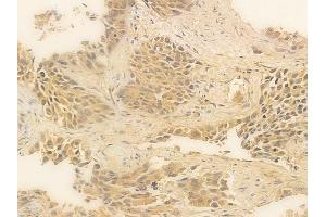 ABIN6256220 and ABIN6267281 at 1/100 staining human lung squamous cell carcinoma by IHC-P. (RAF1 anticorps  (pSer259))