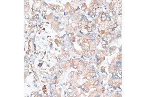 Immunohistochemistry of paraffin-embedded human lung cancer using HMGCR antibody (ABIN6293218) at dilution of 1:100 (40x lens). (HMGCR anticorps)