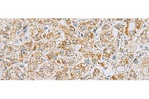 Immunohistochemistry of paraffin-embedded Human liver cancer tissue using INS(C-peptide) Polyclonal Antibody at dilution of 1:40(x200) (Insulin C-Peptide anticorps)