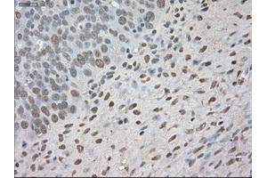 Immunohistochemical staining of paraffin-embedded Adenocarcinoma of colon tissue using anti-BUB1Bmouse monoclonal antibody. (BUB1B anticorps)