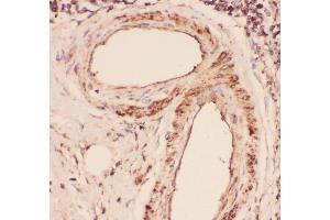 Anti-Desmin Picoband antibody,  IHC(P): Human Intestinal Cancer Tissue