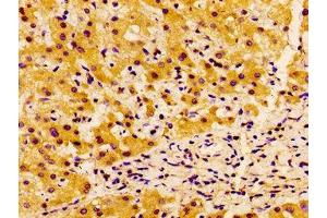 IHC image of ABIN7143574 diluted at 1:100 and staining in paraffin-embedded human liver cancer performed on a Leica BondTM system.