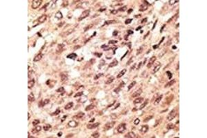 IHC analysis of FFPE human hepatocarcinoma stained with the LRP5 antibody (LRP5 anticorps  (AA 1538-1567))