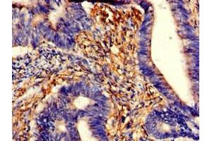 Immunohistochemistry of paraffin-embedded human colon cancer using ABIN7173558 at dilution of 1:100