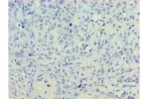 Immunohistochemistry of paraffin-embedded human breast cancer using ABIN7156167 at dilution of 1:100 (PLD5 anticorps  (AA 92-536))
