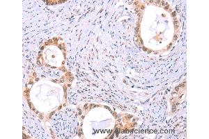 Immunohistochemistry of Human thyroid cancer using PROS1 Polyclonal Antibody at dilution of 1:60 (PROS1 anticorps)