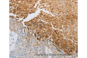 Immunohistochemistry of Human esophagus cancer using RTN4 Polyclonal Antibody at dilution of 1:40