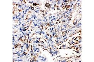 IHC-P: AQP1 antibody testing of human kidney cancer tissue (Aquaporin 1 anticorps  (C-Term))