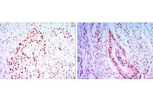 Immunohistochemical analysis of paraffin-embedded lung cancer tissues (left) and colon cancer tissues (right) using CDC27 mouse mAb with DAB staining.