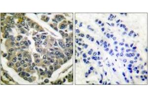 Immunohistochemistry analysis of paraffin-embedded human breast carcinoma tissue, using Collagen IV Antibody. (Collagen IV anticorps  (AA 11-60))