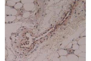 Detection of PSMD13 in Human Skin Cancer Tissue using Polyclonal Antibody to Proteasome 26S Subunit, Non ATPase 13 (PSMD13)