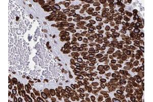ABIN6268709 at 1/100 staining human Pancreas cancer tissues sections by IHC-P. (Lamin B anticorps)