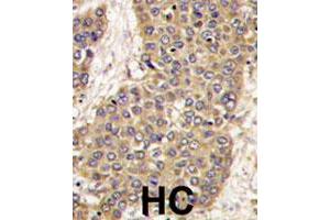 Formalin-fixed and paraffin-embedded human hepatocellular carcinoma reacted with CASP6 polyclonal antibody  , which was peroxidase-conjugated to the secondary antibody, followed by DAB staining. (Caspase 6 anticorps  (C-Term))