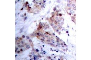Immunohistochemical analysis of ARHGAP23 staining in human breast cancer formalin fixed paraffin embedded tissue section. (ARHGAP23 anticorps)