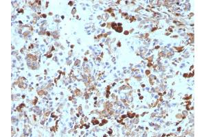 Formalin-fixed, paraffin-embedded human Melanoma stained with MITF Mouse Monoclonal Antibody (MITF/915). (MITF anticorps)