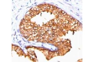 IHC testing of FFPE human prostate carcinoma and ODC antibody (ORN255-1). (ODC1 anticorps)