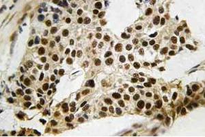 Immunohistochemistry (IHC) analyzes of MAPKAPK-2 antibody in paraffin-embedded human breast carcinoma tissue. (MAPKAP Kinase 2 anticorps)