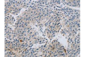 The image on the left is immunohistochemistry of paraffin-embedded Human liver cancer tissue using ABIN7191430(MCMBP Antibody) at dilution 1/60, on the right is treated with synthetic peptide. (MCMBP anticorps)