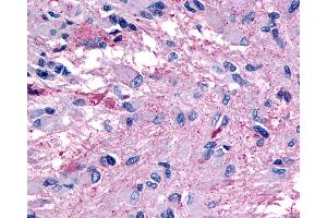 Anti-GPR139 antibody IHC of human Brain, Glioblastoma.