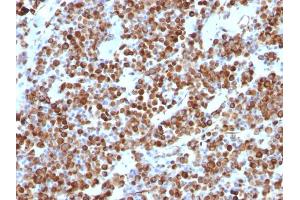 Formalin-fixed, paraffin-embedded human Melanoma stained with Vimentin Mouse Monoclonal Antibody (VM452).