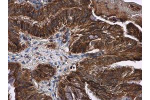 IHC-P Image LOXL2 antibody detects LOXL2 protein at cytoplasm and membrane in human cervical carcinoma by immunohistochemical analysis. (LOXL2 anticorps)