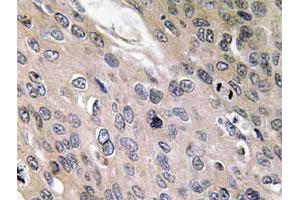 Immunohistochemical analysis of paraffin-embedded human lung cancer tissue using BMP6 polyclonal antibody . (BMP6 anticorps)