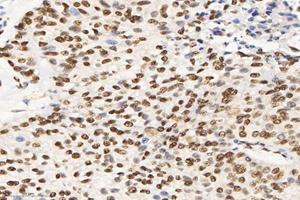 Immunohistochemistry analysis of paraffin-embedded human lung cancer using SET (ABIN7075583) at dilution of 1: 10000