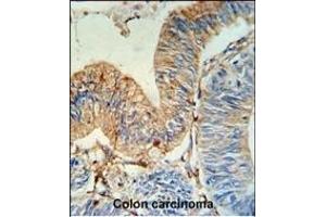 HLA-DRA Antibody (N-term) (ABIN390770 and ABIN2841028) IHC analysis in formalin fixed and paraffin embedded human colon carcinoma followed by peroxidase conjugation of the secondary antibody and DAB staining. (HLA-DRA anticorps  (N-Term))