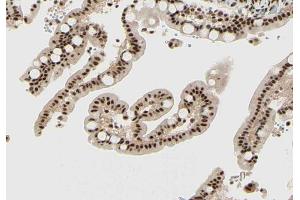 ABIN6267564 at 1/200 staining human colon cancer tissue sections by IHC-P.
