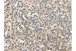 The image on the left is immunohistochemistry of paraffin-embedded Human esophagus cancer tissue using ABIN7192147(RASA2 Antibody) at dilution 1/45, on the right is treated with synthetic peptide. (RASA2 anticorps)