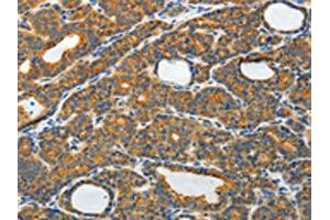 The image on the left is immunohistochemistry of paraffin-embedded Human thyroid cancer tissue using ABIN7130809(RAMP3 Antibody) at dilution 1/40, on the right is treated with fusion protein. (RAMP3 anticorps)