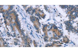 Immunohistochemistry of paraffin-embedded Human colon cancer tissue using PLIN1 Polyclonal Antibody at dilution 1:30 (PLIN1 anticorps)