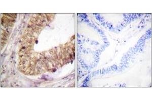Immunohistochemistry analysis of paraffin-embedded human colon carcinoma tissue, using ATRIP (Ab-68/72) Antibody. (ATRIP anticorps  (AA 34-83))
