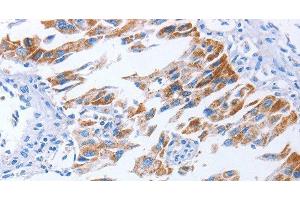 Immunohistochemistry of paraffin-embedded Human lung cancer using KIF3A Polyclonal Antibody at dilution of 1:40 (KIF3A anticorps)