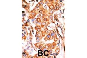 Formalin-fixed and paraffin-embedded human cancer tissue reacted with the primary antibody, which was peroxidase-conjugated to the secondary antibody, followed by AEC staining.