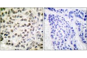 Immunohistochemistry analysis of paraffin-embedded human breast carcinoma tissue, using POLR2A (Ab-1619) Antibody. (POLR2A/RPB1 anticorps  (AA 1585-1634))