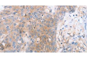 Immunohistochemistry of paraffin-embedded Human esophagus cancer tissue using CD85d Polyclonal Antibody at dilution 1:30 (LILRB2 anticorps)