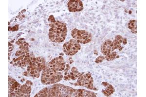 IHC-P Image Immunohistochemical analysis of paraffin-embedded SW480 Xenograft, using S100A11, antibody at 1:500 dilution. (S100A11 anticorps)