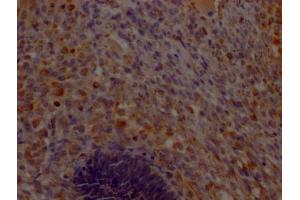 IHC image of ABIN7148184 diluted at 1:200 and staining in paraffin-embedded human ovarian cancer performed on a Leica BondTM system. (CHCHD5 anticorps  (AA 1-110))