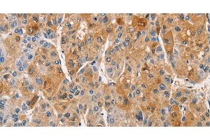 Immunohistochemistry of paraffin-embedded Human liver cancer using PKC epsilon Polyclonal Antibody at dilution of 1:50 (PKC epsilon anticorps)
