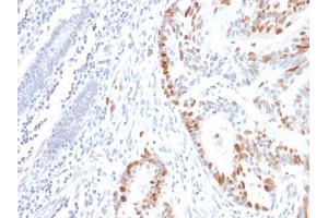 Formalin-fixed, paraffin-embedded human Colon Carcinoma stained with p53 Mouse Recombinant Monoclonal Antibody (rBP53-12).