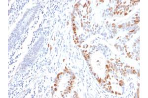 Formalin-fixed, paraffin-embedded human Colon Carcinoma stained with p53 Mouse Recombinant Monoclonal Antibody (rBP53-12). (Recombinant p53 anticorps)