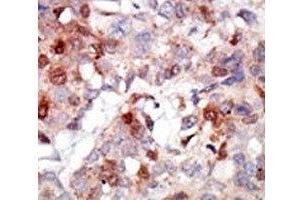 IHC analysis of FFPE human breast carcinoma tissue stained with the AKT3 antibody