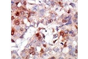 IHC analysis of FFPE human breast carcinoma tissue stained with the AKT3 antibody (AKT3 anticorps  (AA 88-118))